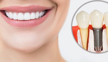What Should I Expect After Dental Implant Treatment?