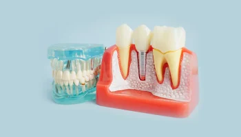 When Should You Get Dental Implants? Age Guidelines You Need to Know