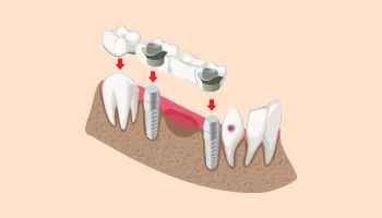 Wondering How Long a Dental Bridge Takes in Paoli, PA? Here’s the Full Breakdown